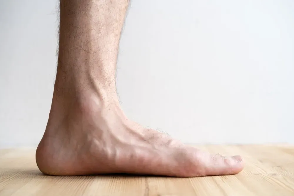 Are Flat Feet a Health Concern?